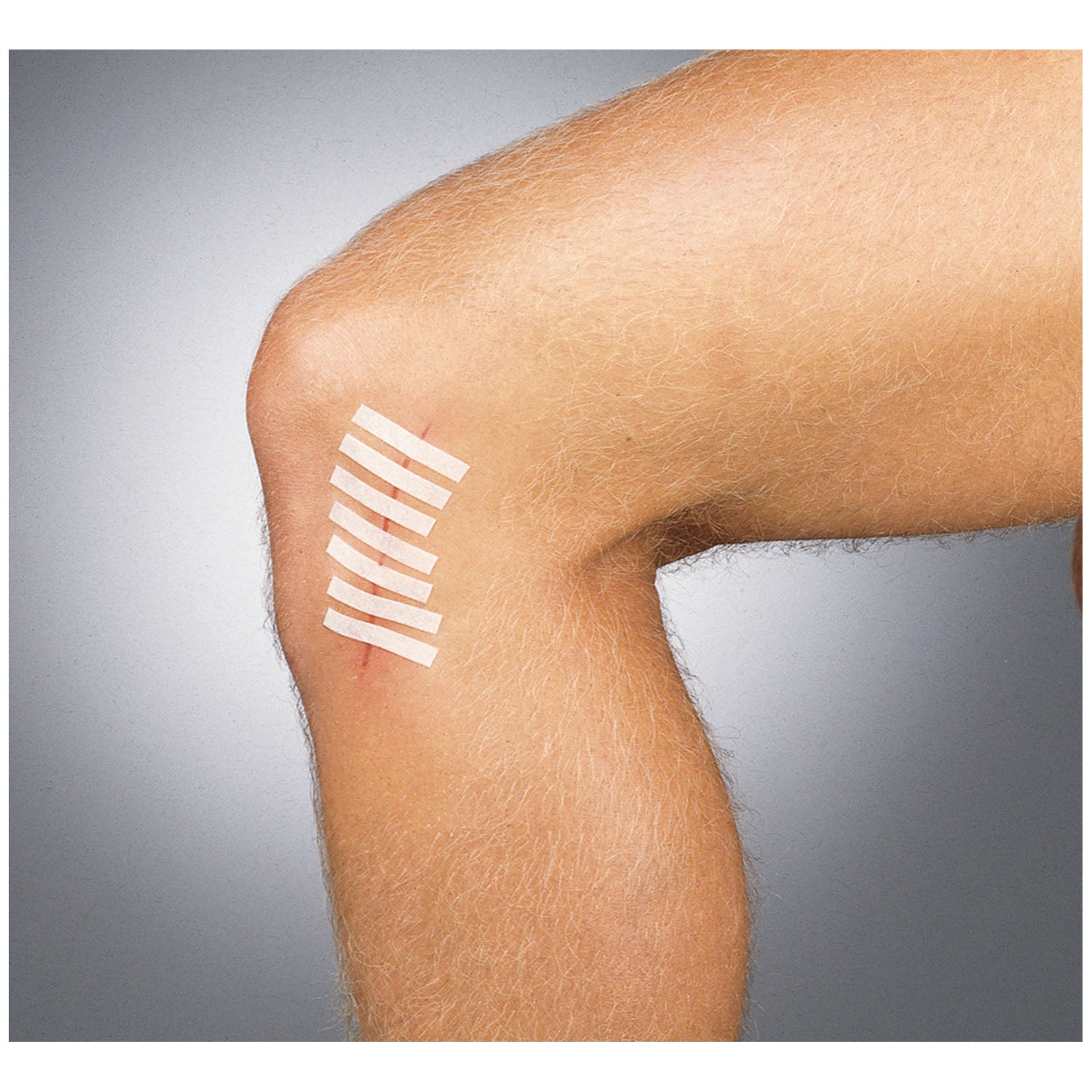 GENTELL SUTURE STRIP® WOUND CLOSURE STRIPS 